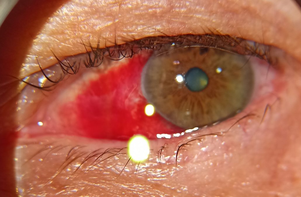 göz kanaması subkonjonktival hemoraji