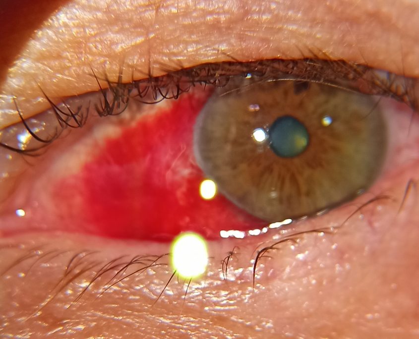 subkonjonktival hemoraji